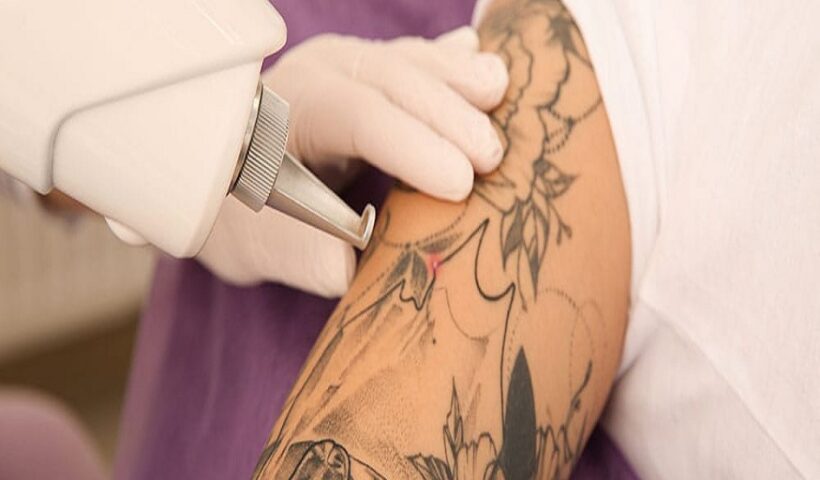 Learn About Laser Tattoo Removal
